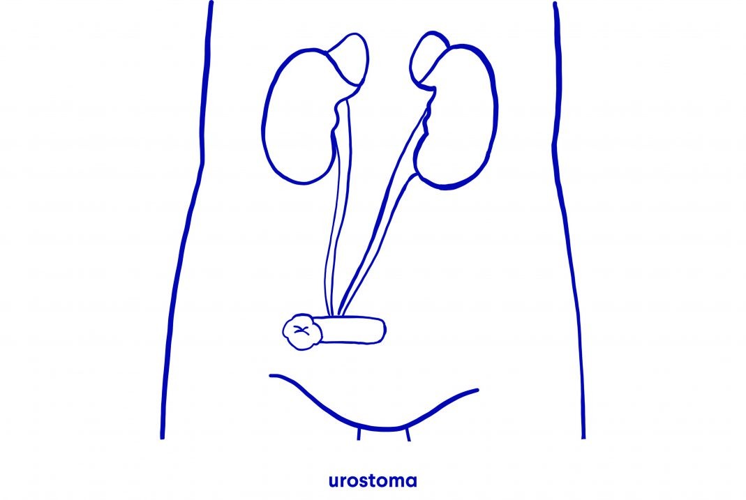 Urinestoma